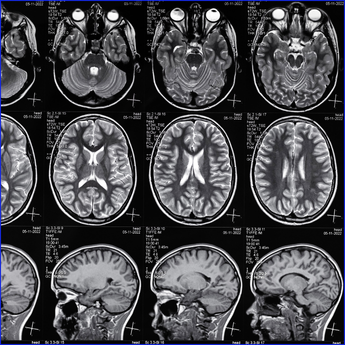 Types of Brain Injuries You Can Claim Compensation For Types of Brain Injuries You Can Claim Compensation For
